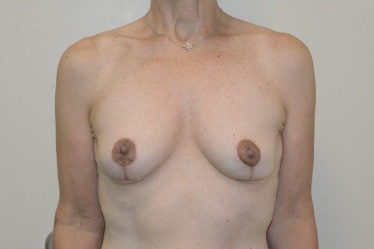 After Image: Breast Implant Removal with Lift – Before & After Case 13 - front