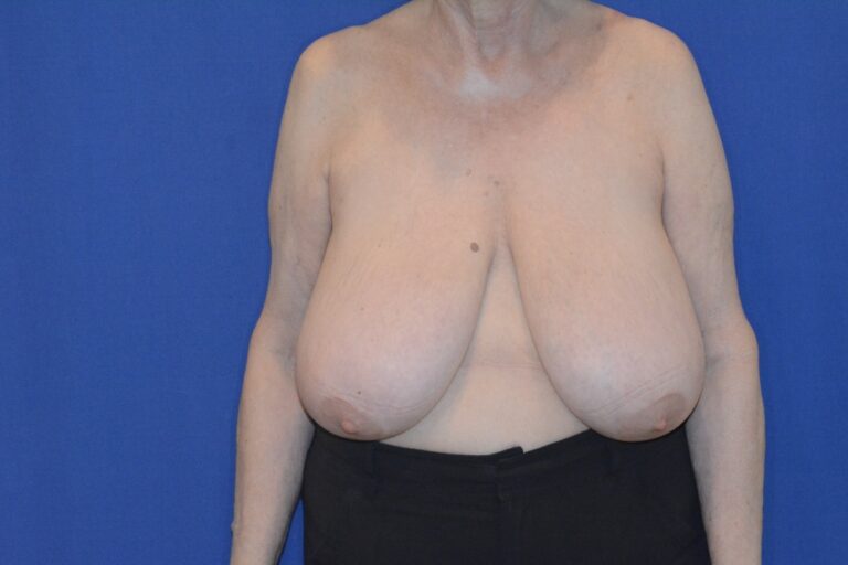 Before Image: Breast Reduction – Before & After Case 37 - front