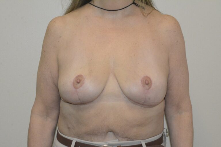 After Image: Breast Implant Removal with Lift – Before & After Case 16 - front