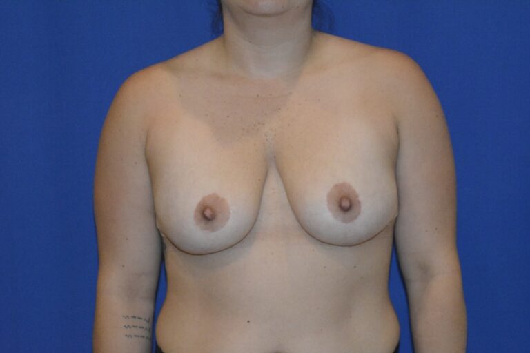 Before Image: Breast Implant Removal – Before & After Case 18 - front