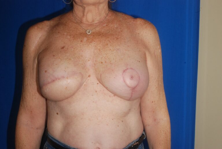 After Image: Breast Reconstruction – Latissimus Flap – Before & After Case 43 - front