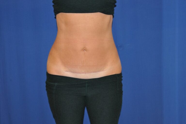 After Image: Liposuction Abd/Flanks with Mini-TT – Before & After Case 14 - front