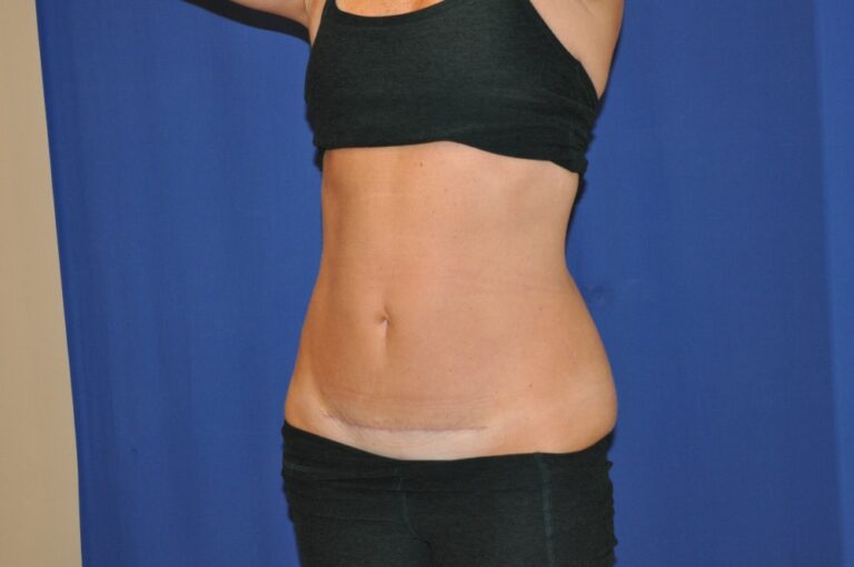 After Image: Liposuction Abd/Flanks with Mini-TT – Before & After Case 14 - left-front-oblique