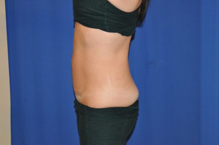 After Image: Liposuction Abd/Flanks with Mini-TT – Before & After Case 14 - left-side