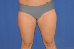 After Image: Liposuction – Inner/Outer Thighs – Before & After Case 15