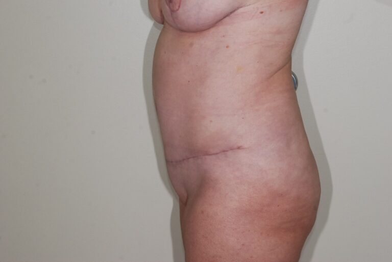 After Image: Tummy Tuck – Before & After Case 16 - left-side