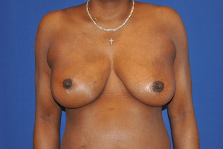 Before Image: Breast Reconstruction – Implant Based – Before & After Case 56 - front