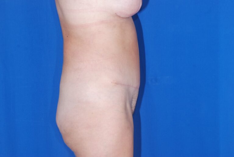 After Image: Tummy Tuck – Before & After Case 15 - right-side