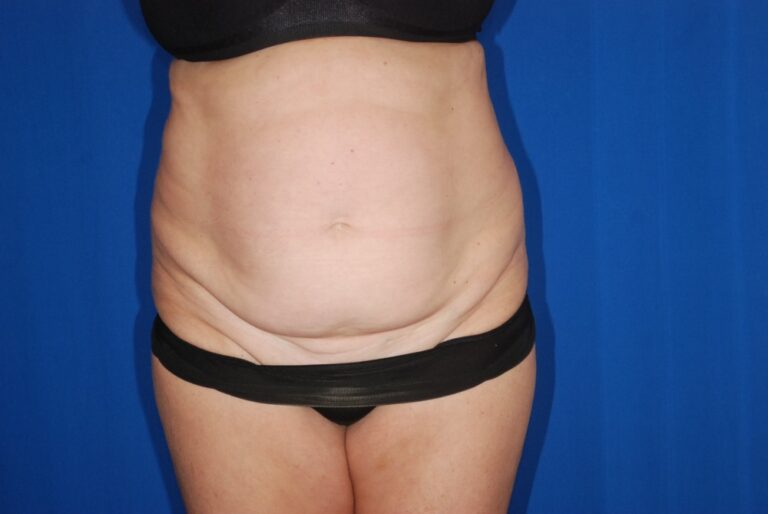 Before Image: Tummy Tuck – Before & After Case 16 - front