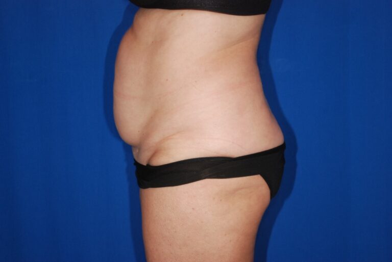 Before Image: Tummy Tuck – Before & After Case 16 - left-side