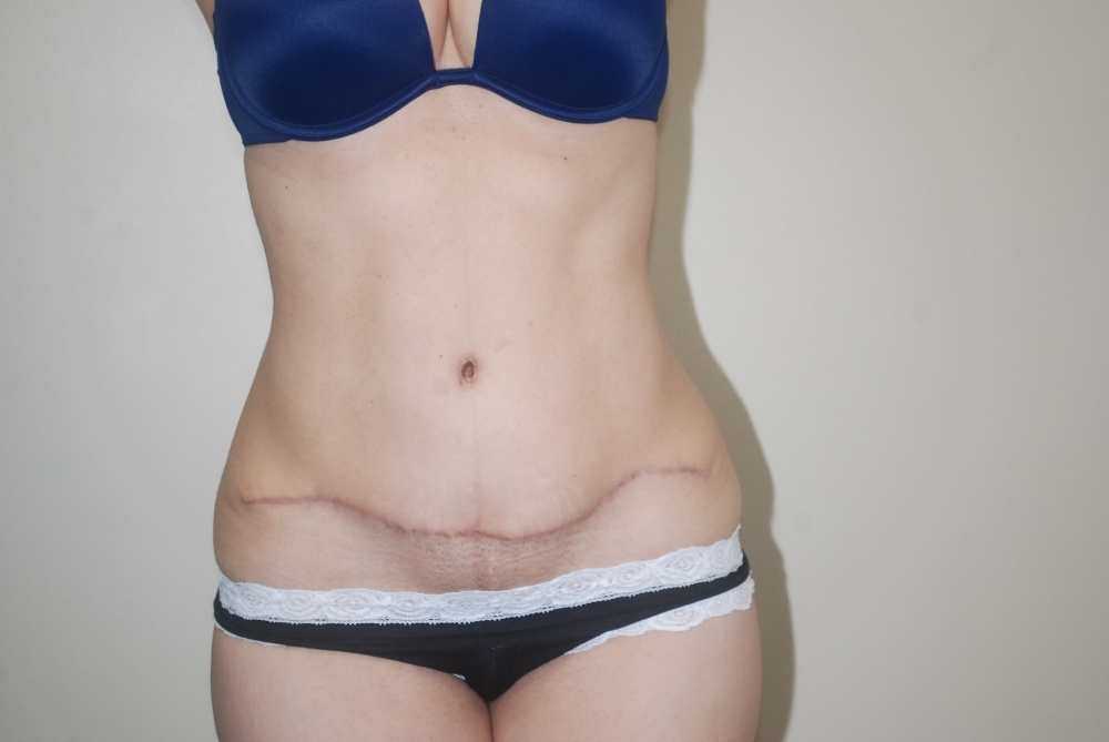 Case 14: front view of abdomen and belly button after tummy tuck surgery