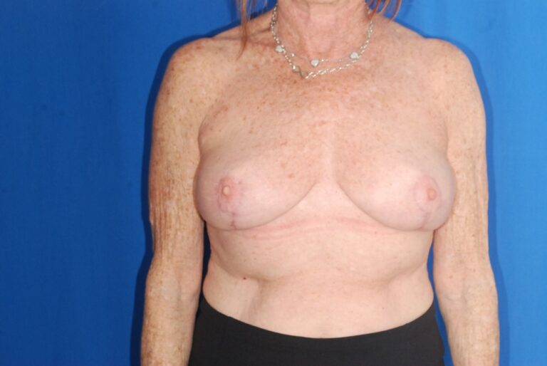 After Image: Breast Reduction – Before & After Case 31 - front