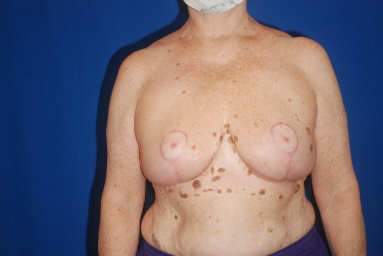 After Image: Breast Reduction – Before & After Case 24 - front
