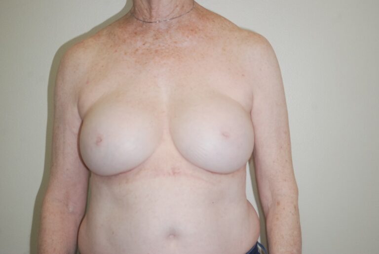 After Image: Breast Implant Revision – Before & After Case 13 - front