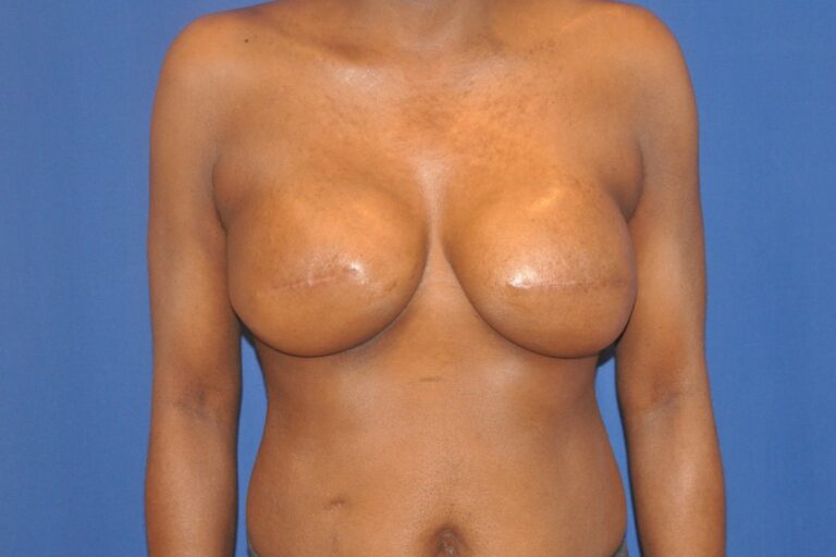 After Image: Breast Reconstruction – Implant Based – Before & After Case 56 - front