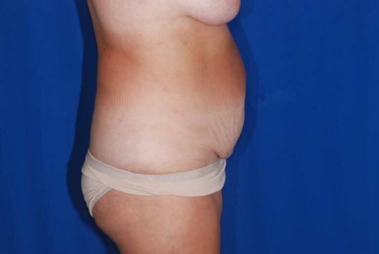 Before Image: Tummy Tuck – Before & After Case 15 - right-side