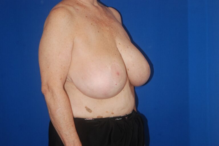Before Image: Breast Reduction – Before & After Case 24 - right-front-oblique