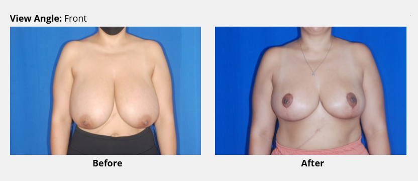 Breast reduction before and after picture front view, Dr. David Bogue in Boca Raton