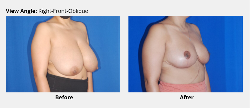 Breast reduction before and after picture oblique view, Dr. David Bogue in Boca Raton