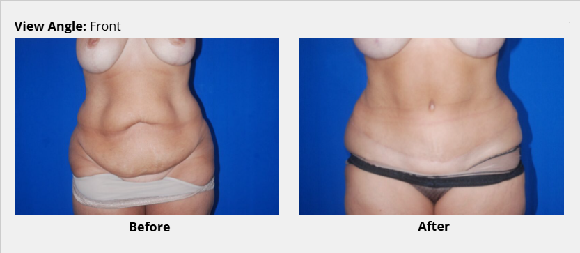 Tummy tuck before and after picture front view, Dr. David Bogue in Boca Raton