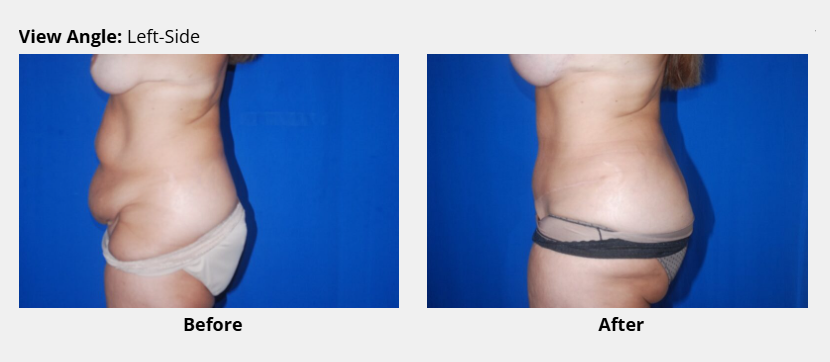 Tummy tuck before and after picture side view, Dr. David Bogue in Boca Raton